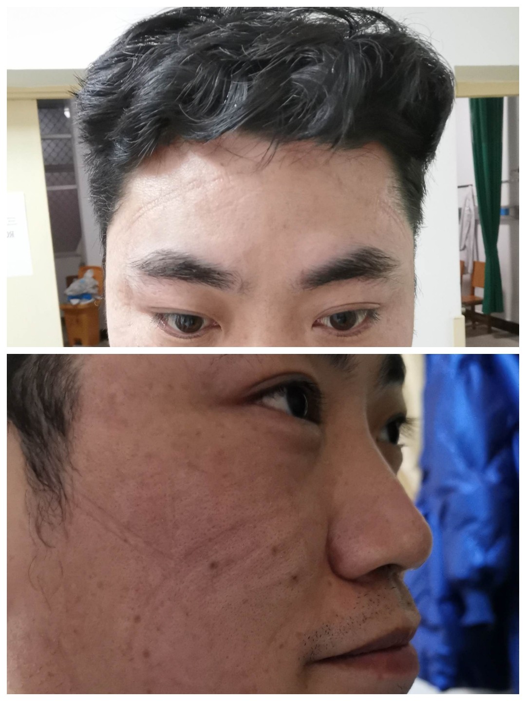 脸上的勒痕.jpeg